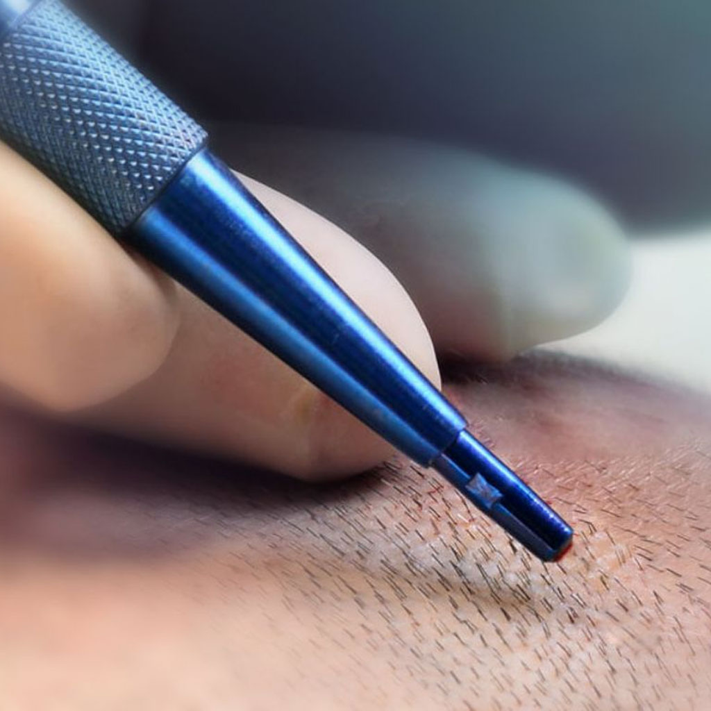 FUE Sapphire Hair Transplant